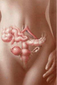 simptome chist ovarian si tratamentul femeilor, kistablog