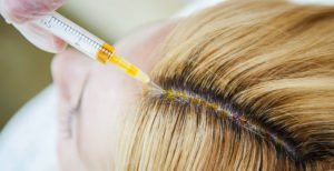 păr Crioterapia ca azot lichid afectează modul în care procedura și tratament