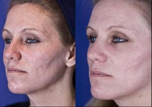 Peelingul cu laser și resurfacing feței - ceea ce este