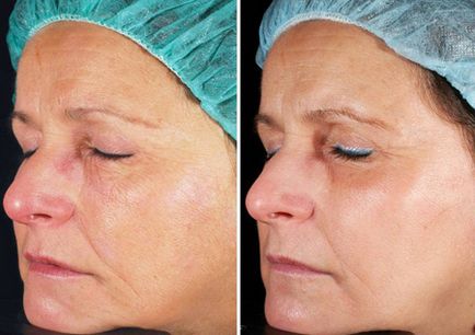 Laser Peelingul facial - descrierea, contraindicații, foto, comentarii, preturi