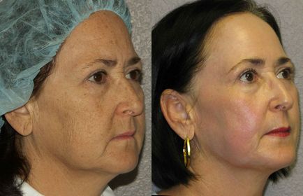 Laser Peelingul facial - descrierea, contraindicații, foto, comentarii, preturi