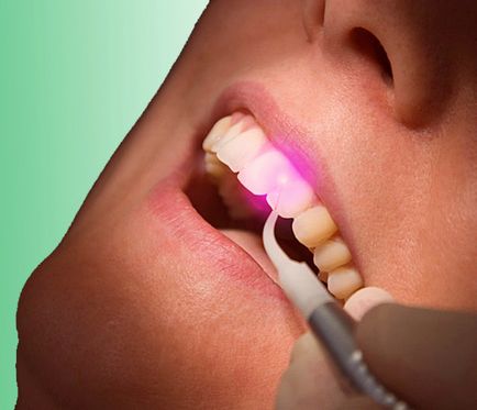 Tratamentul cu laser al dentare cariilor plusuri și minusuri metoda