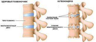 Terapie prin Masaj în osteocondrozei coloanei cervicale, cauze, simptome, diagnostic,