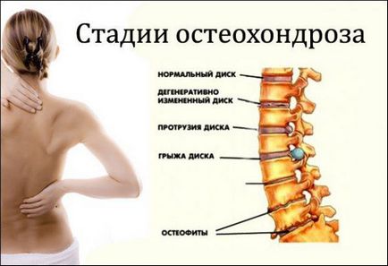 Terapie prin Masaj în osteocondrozei coloanei cervicale, cauze, simptome, diagnostic,