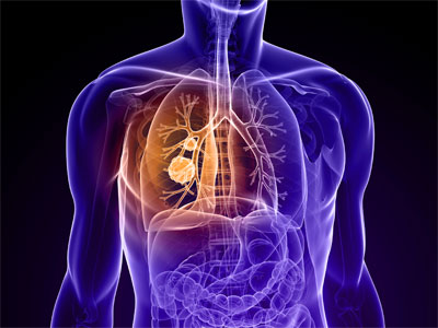 Tratamentul de emfizem pulmonar folosind remedii populare