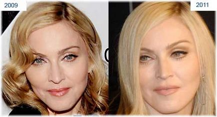 Madonna fotografii chirurgie plastica înainte și după