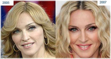 Madonna fotografii chirurgie plastica înainte și după