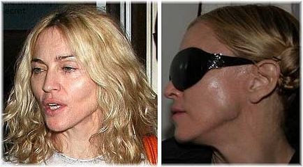 Madonna fotografii chirurgie plastica înainte și după