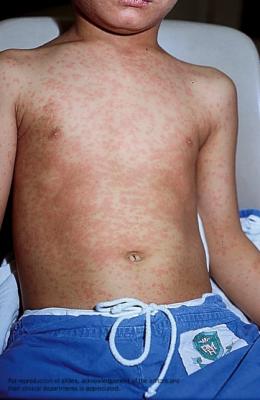 rash maculopapulara poate fi un simptom al bolii