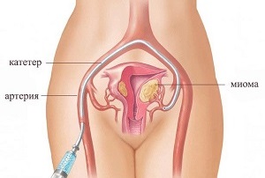 Metode de tratare a fibrom uterin, fara interventii chirurgicale si cu experienta comentarii