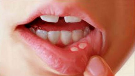 Sturz în simptomele copilului gurii, fotografie, forme, tratament, prevenirea candidoză