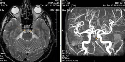 Expert RMN, angiografie MR în studiul arterelor cerebrale
