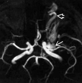 Expert RMN, angiografie MR în studiul arterelor cerebrale