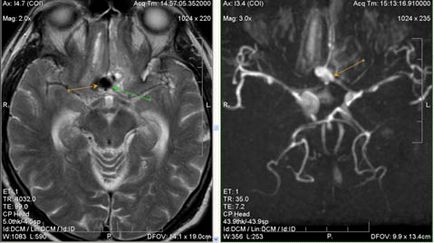 Expert RMN, angiografie MR în studiul arterelor cerebrale