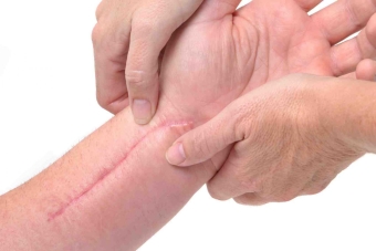 remedii populare pentru cicatrici pentru rezolutia si netezirea pielii