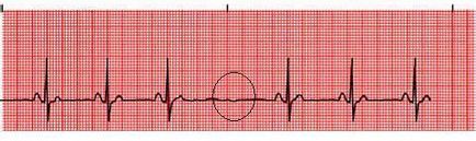 conducere intraventriculare, intraatriale