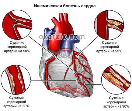 Perturbarea de conducere intraventriculare a inimii, care este