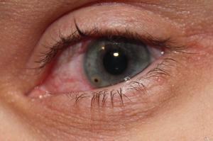 Nu a fost eliminat eyewinker cum să eliminați, ce să facă în caz de deteriorare a ochilor obiecte străine