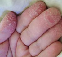 piele Oblazit pe degetele de la copii și adulți o iritație obișnuită sau boli periculoase