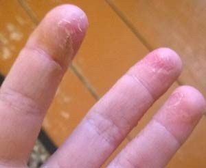 piele Oblazit pe degetele de la copii și adulți o iritație obișnuită sau boli periculoase