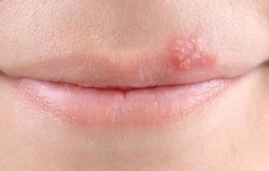 herpes unguent oxalinic pe buze și cât de mult pentru a murdări