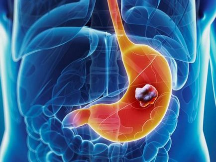 Cancerul de stomac tipuri de tumori benigne și maligne, cauzele si simptomele lor, tratament