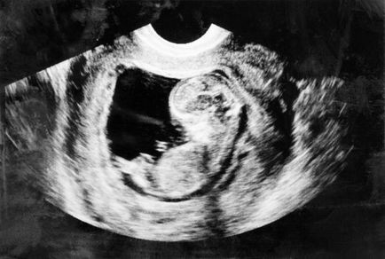 Determinarea sexul copilului pe ultrasunete, cât mai exact