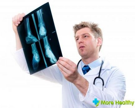 Principalele semne ale tratamentelor fractura picior