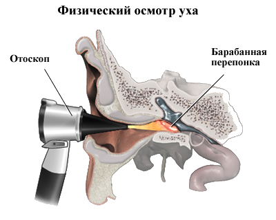 infecție acută a urechii
