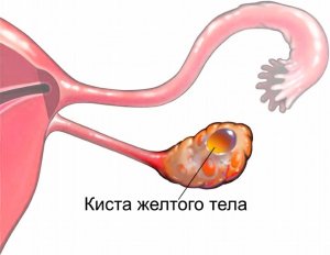 În cazul în care face un chist ovarian, dezvoltarea diferitelor tipuri de chisturi și diagnosticarea problemelor