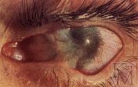 Ochii Burns - cauze, simptome, diagnostic și tratament
