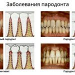 simptome de boala parodontala si tratamentul la domiciliu