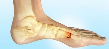 Fractura oasele metatarsiene ale piciorului - simptome, tratament, reabilitare după fractura oaselor metatarsiene