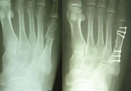 Fracturarea piciorului (metatarsiene,), tratat ca mers pe jos într-un ghips, simptomele