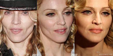 Chirurgia plastica Madonna (Madonna mamoplastia) Chirurgie plastica Madonna