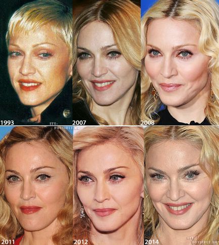 Chirurgie plastica Madonna