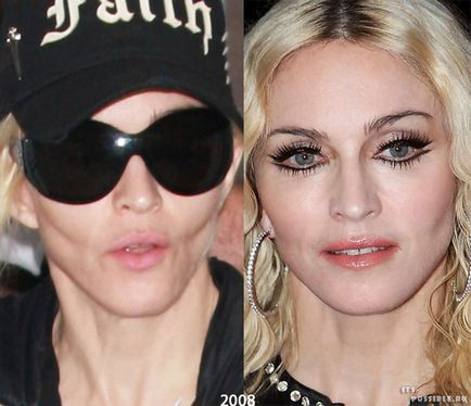Chirurgie plastica Madonna