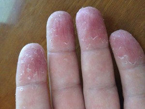 De ce degetele oblazit cauze ale pielii și descrierea unor boli posibile, sfaturi privind îngrijirea