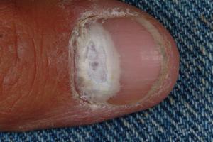 De ce degetele oblazit cauze ale pielii și descrierea unor boli posibile, sfaturi privind îngrijirea