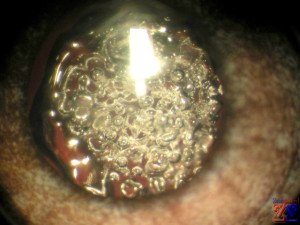 De ce există o cataractă secundară și modul în care este tratată