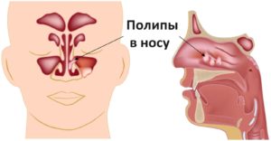 Tratamentul polipilor nazali fara tehnici de chirurgie și recenzii