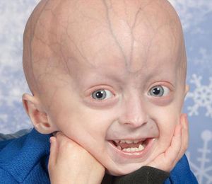 semne Progeria de progeria și descriere