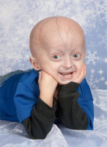 Progeria (sindromul Hutchinson-Gilford) - o boala care pune viața în portal 