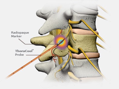 Radiofrecventa denervare de durere la nivelul coloanei vertebrale
