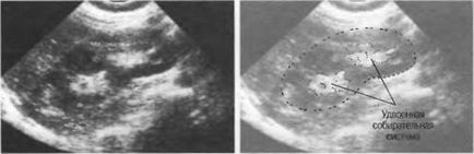 Descifrarea standarde cu ultrasunete de rinichi pentru femei și bărbați