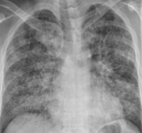 Sindromul de detresă respiratorie - cauze, simptome, diagnostic și tratament