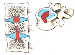 Simptomele unei hernie ombilicala la adulți, și simptome tipice