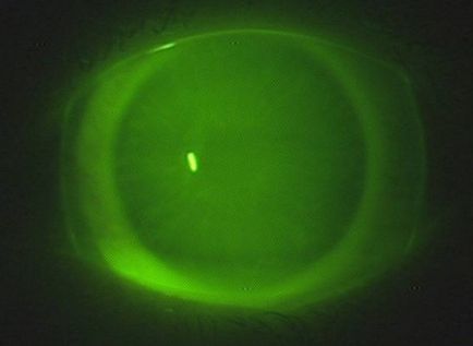 instrucțiuni lentile sclerală privind utilizarea foto (sclerală) instrucțiuni lentile sclerală cu privire la utilizarea de fotografii