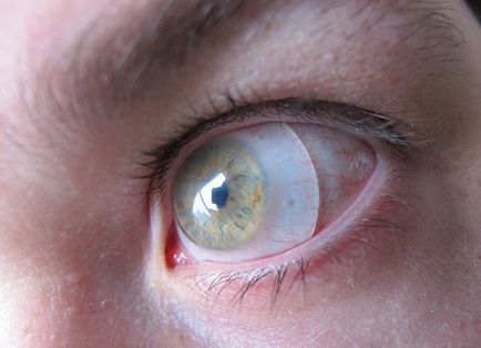 instrucțiuni lentile sclerală privind utilizarea fotografiei (pentru a permite umezelii) instrucțiuni lentile sclerală cu privire la utilizarea de fotografii