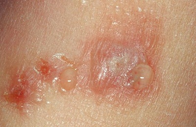 eczeme uscate pe mâini decât pentru a trata simptomele și cauzele